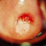 τυπική εικόνα μωσαϊκου σε HPV
